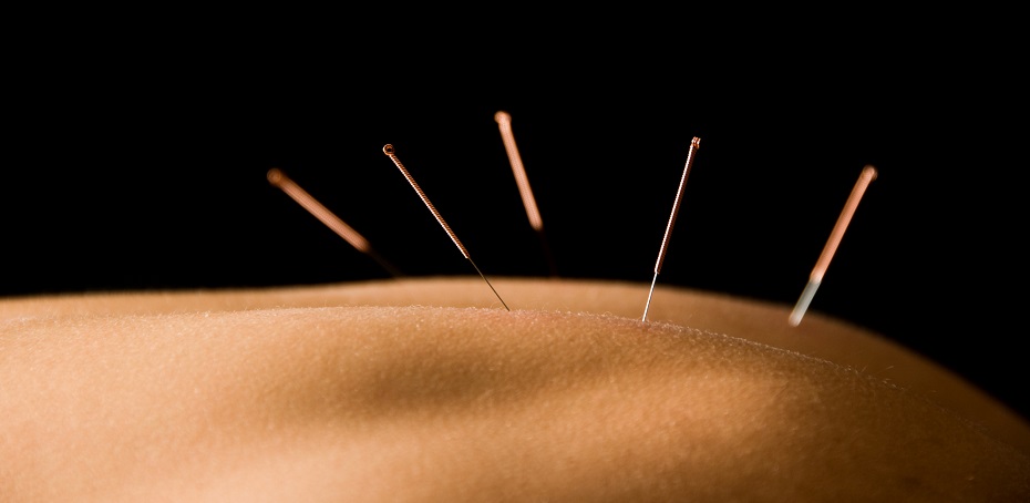 Acupuncture for back pain in Halifax