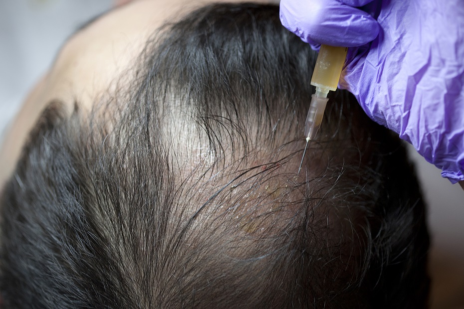 Platelet-rich plasma (PRP) injection treatment for treatment of hair loss