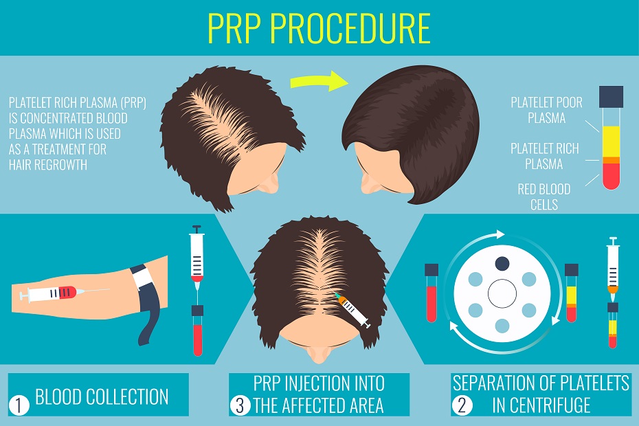 Platelet-Rich Plasma For Hair Loss - Dr. Colin MacLeod ND