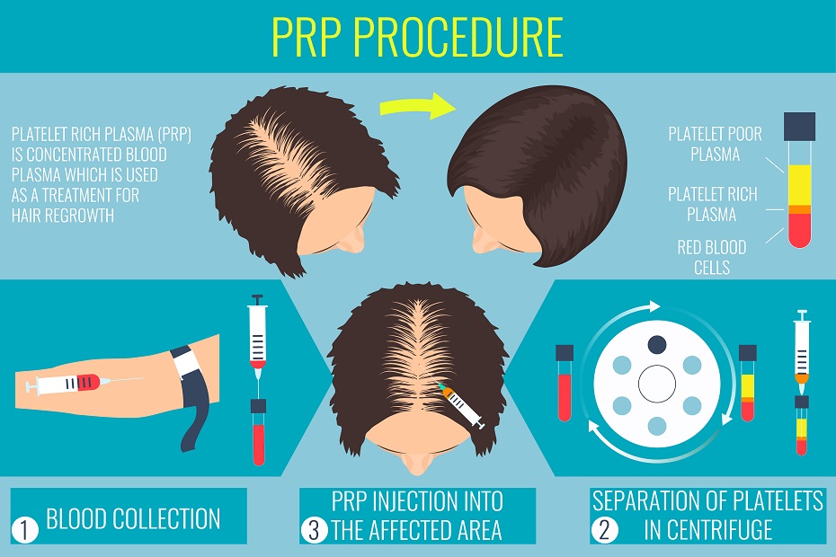 Platelet-rich plasma (PRP) injection treatment for treatment of hair loss