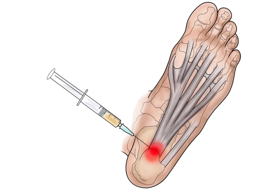 Platelet-rich plasma  injection for plantar fasciitis