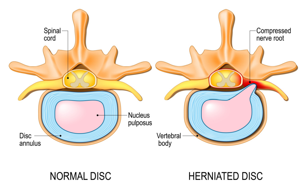 Herniated disc anatomy