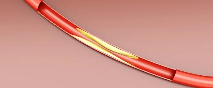 Arteriosclerosis - cardiovascular disease progression showing healthy artery, plaque buildup and advanced blockage