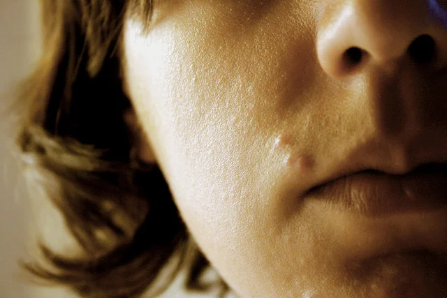 Acne, Eczema & Psoriasis: Natural Treatment Approaches