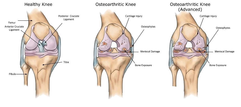 Osteoarthritis knee joint