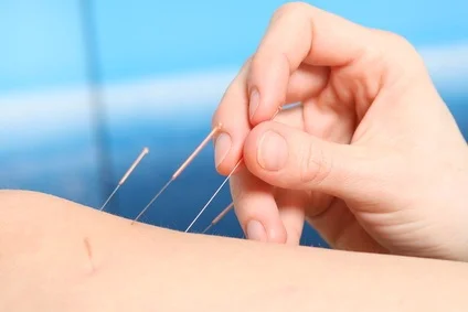 Ear acupuncture for smoking cessation