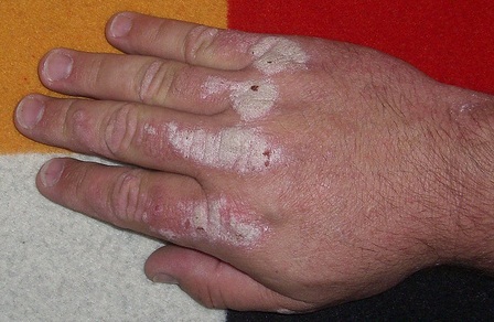 Psoriasis