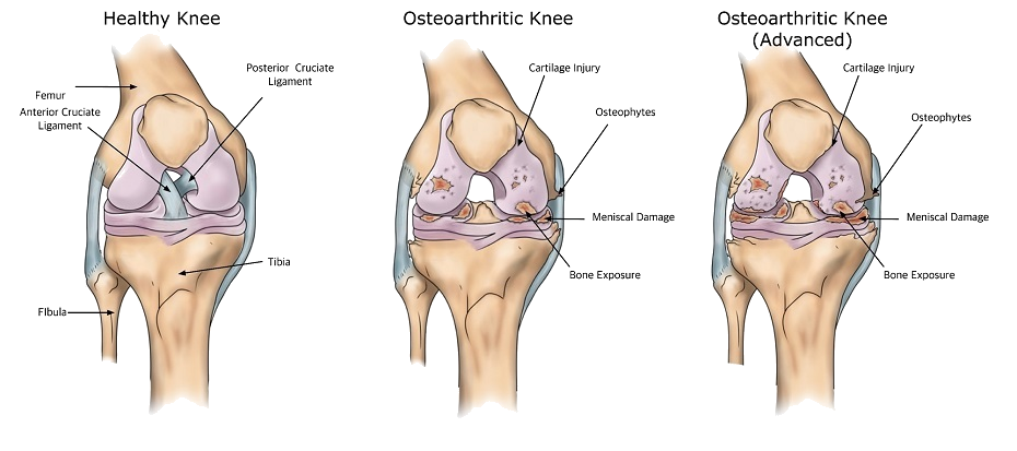 Arthritis of knee prp