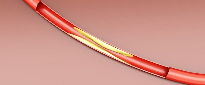 Arteriosclerosis - cardiovascular disease